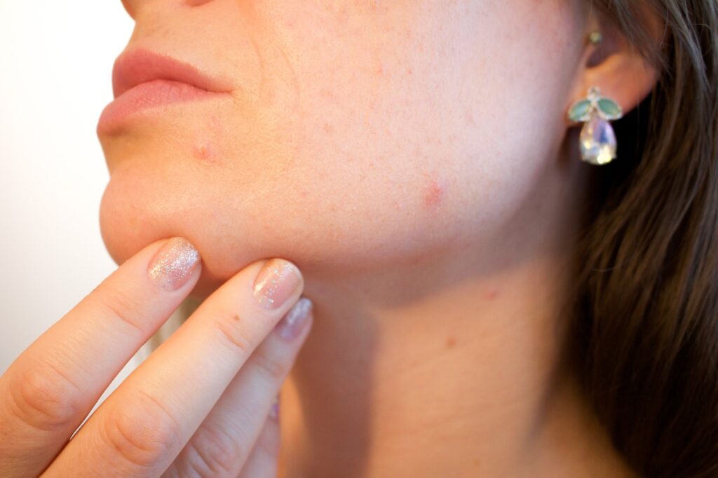 Comment ne pas avoir d’acné en prise de masse ?